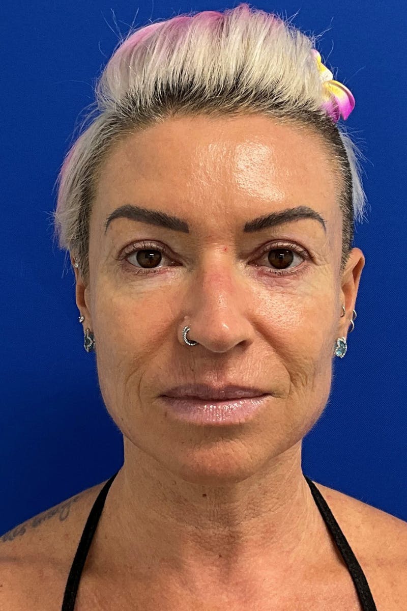 Blepharoplasty Before & After Gallery - Patient 168095 - Image 2
