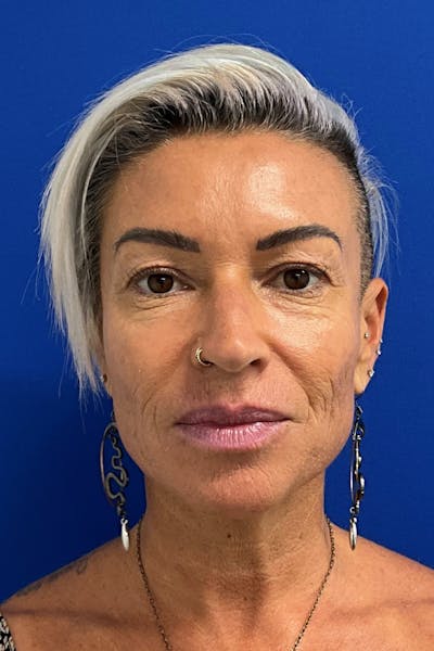 Blepharoplasty Before & After Gallery - Patient 168095 - Image 1