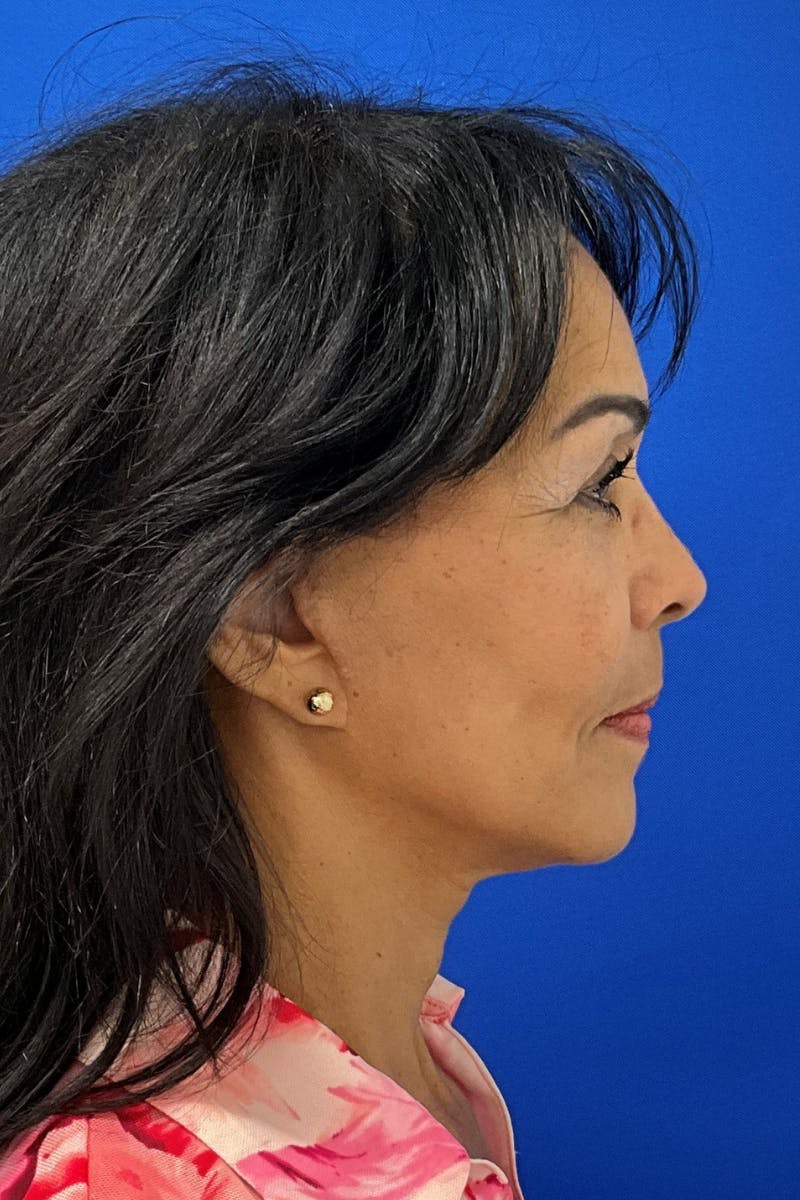 Facelift Before & After Gallery - Patient 107403 - Image 4