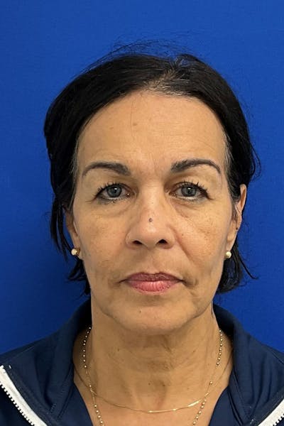 Blepharoplasty Before & After Gallery - Patient 333139 - Image 1