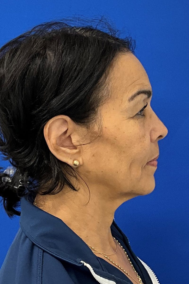 Facelift Before & After Gallery - Patient 107403 - Image 3