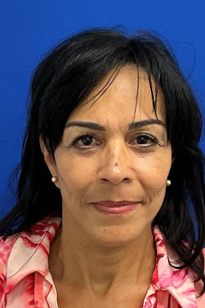 Blepharoplasty Before & After Gallery - Patient 333139 - Image 2