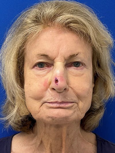 Reconstruction after Mohs Surgery Before & After Gallery - Patient 410620 - Image 1