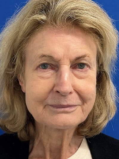 Reconstruction after Mohs Surgery Before & After Gallery - Patient 410620 - Image 2