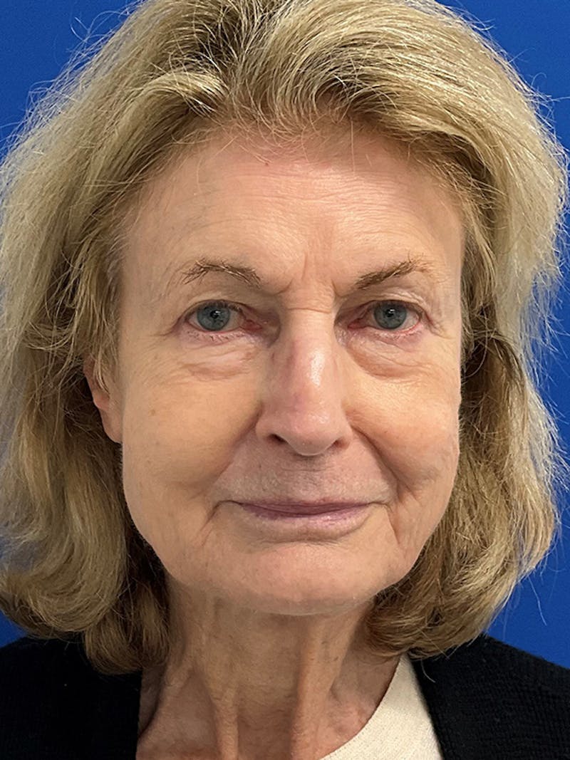 Reconstruction after Mohs Surgery Before & After Gallery - Patient 410620 - Image 2