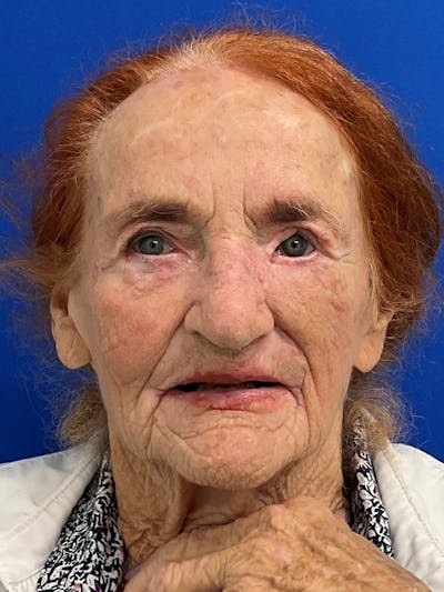 Reconstruction after Mohs Surgery Before & After Gallery - Patient 652801 - Image 2