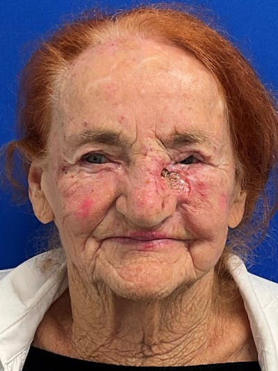 Reconstruction after Mohs Surgery Before & After Gallery - Patient 652801 - Image 1