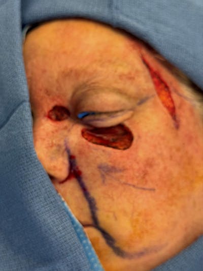 Reconstruction after Mohs Surgery Before & After Gallery - Patient 353418 - Image 1
