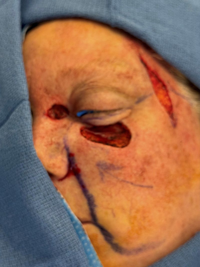 Reconstruction after Mohs Surgery Before & After Gallery - Patient 353418 - Image 1