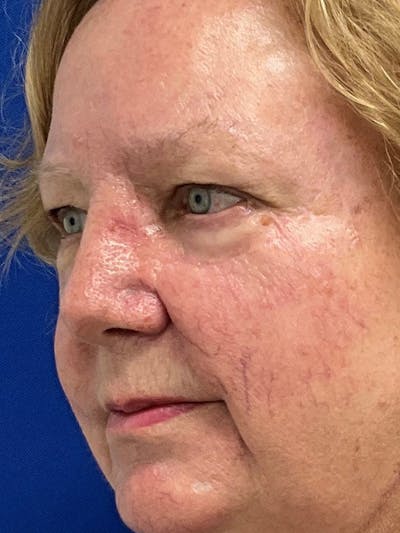 Reconstruction after Mohs Surgery Before & After Gallery - Patient 353418 - Image 2