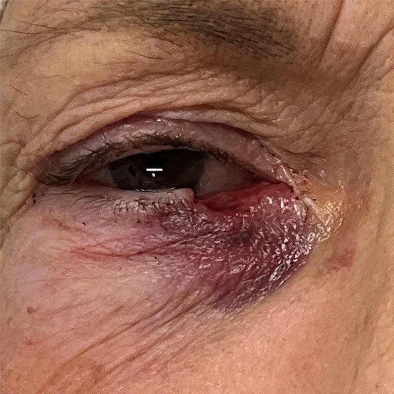 Reconstruction after Mohs Surgery Before & After Gallery - Patient 305435 - Image 1