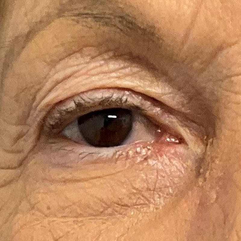 Reconstruction after Mohs Surgery Before & After Gallery - Patient 305435 - Image 2