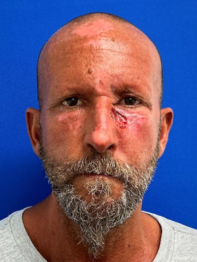 Reconstruction after Mohs Surgery Before & After Gallery - Patient 366190 - Image 1