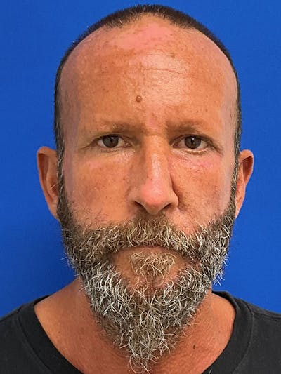 Reconstruction after Mohs Surgery Before & After Gallery - Patient 366190 - Image 2