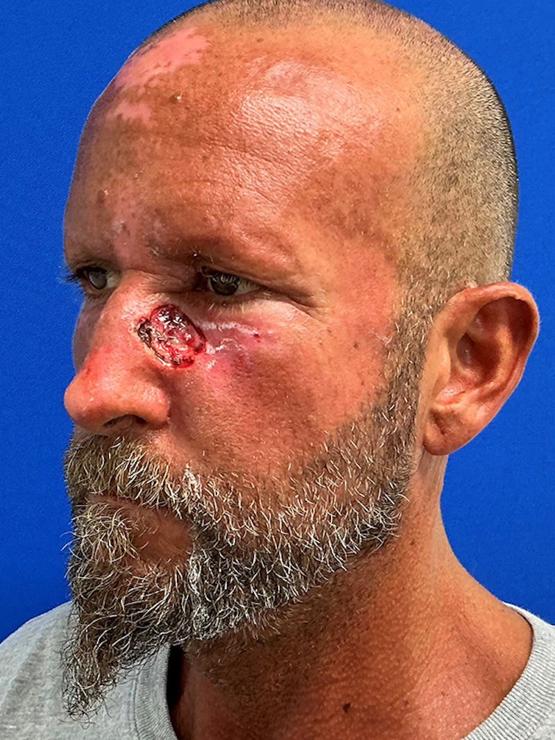 Reconstruction after Mohs Surgery Before & After Gallery - Patient 366190 - Image 3