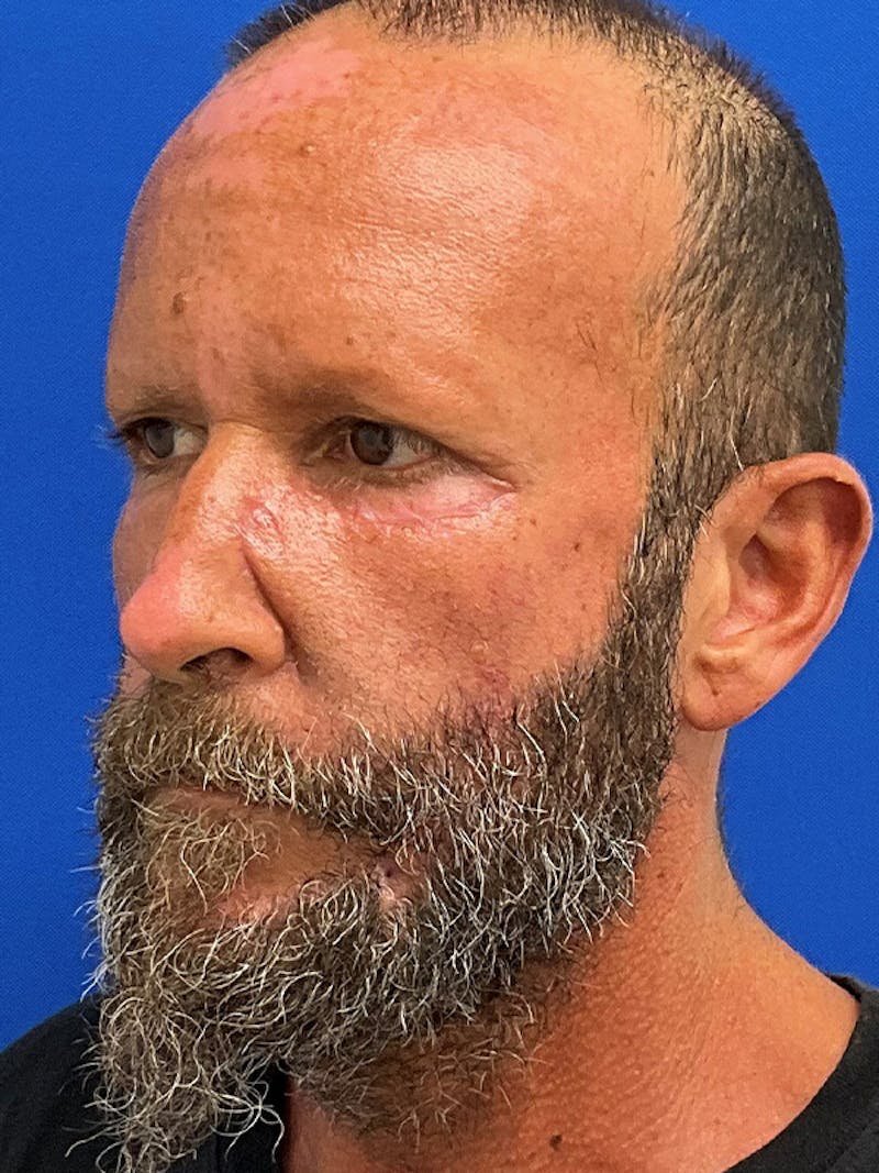 Reconstruction after Mohs Surgery Before & After Gallery - Patient 366190 - Image 4
