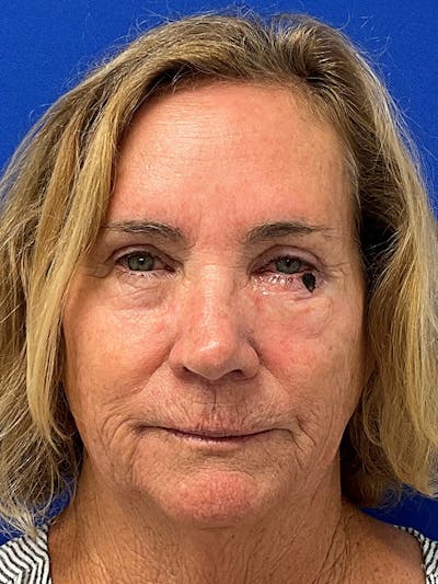 Reconstruction after Mohs Surgery Before & After Gallery - Patient 393805 - Image 1