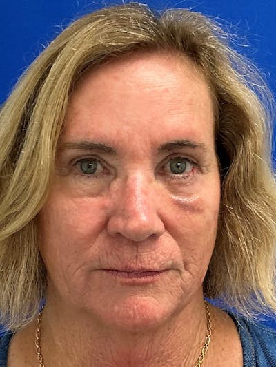 Reconstruction after Mohs Surgery Before & After Gallery - Patient 393805 - Image 2