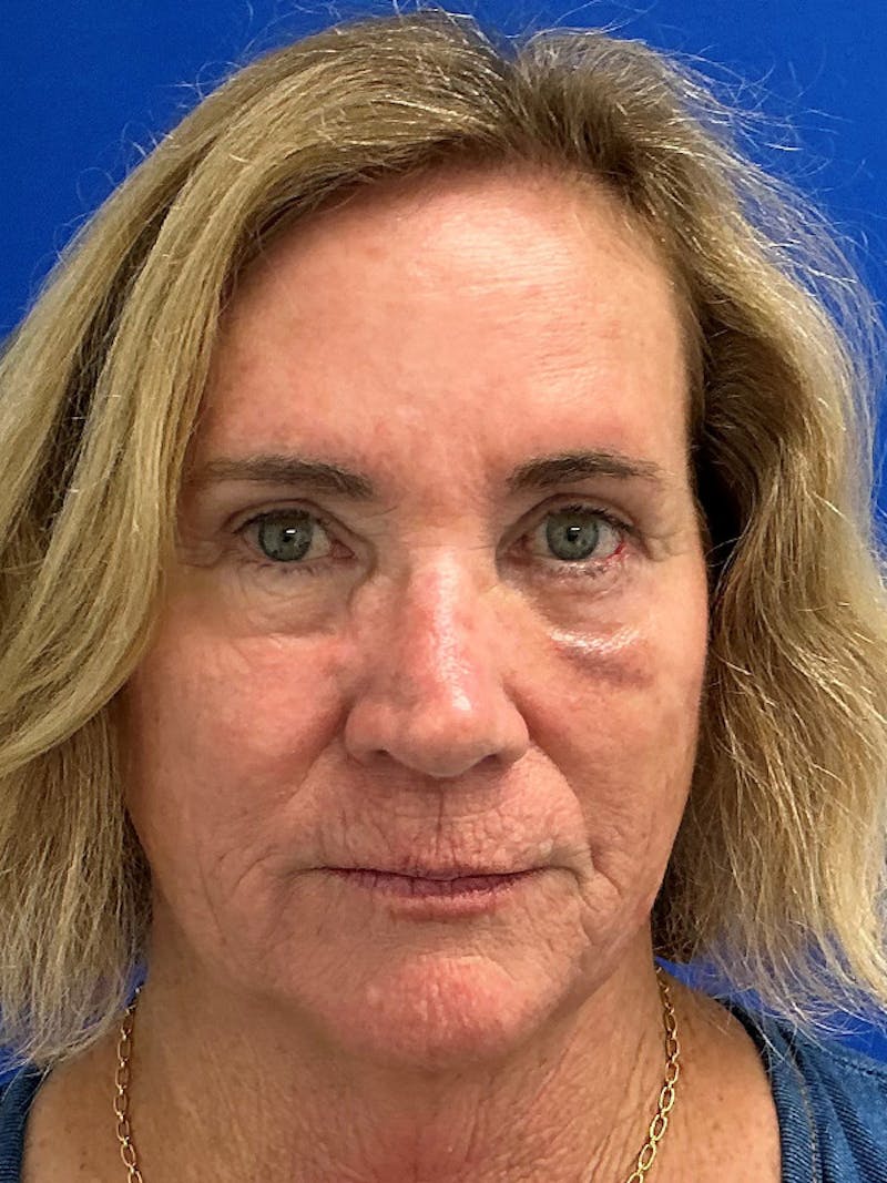 Reconstruction after Mohs Surgery Before & After Gallery - Patient 393805 - Image 2