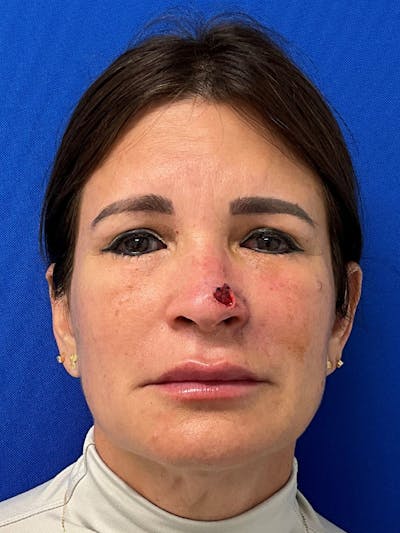 Reconstruction after Mohs Surgery Before & After Gallery - Patient 250804 - Image 1
