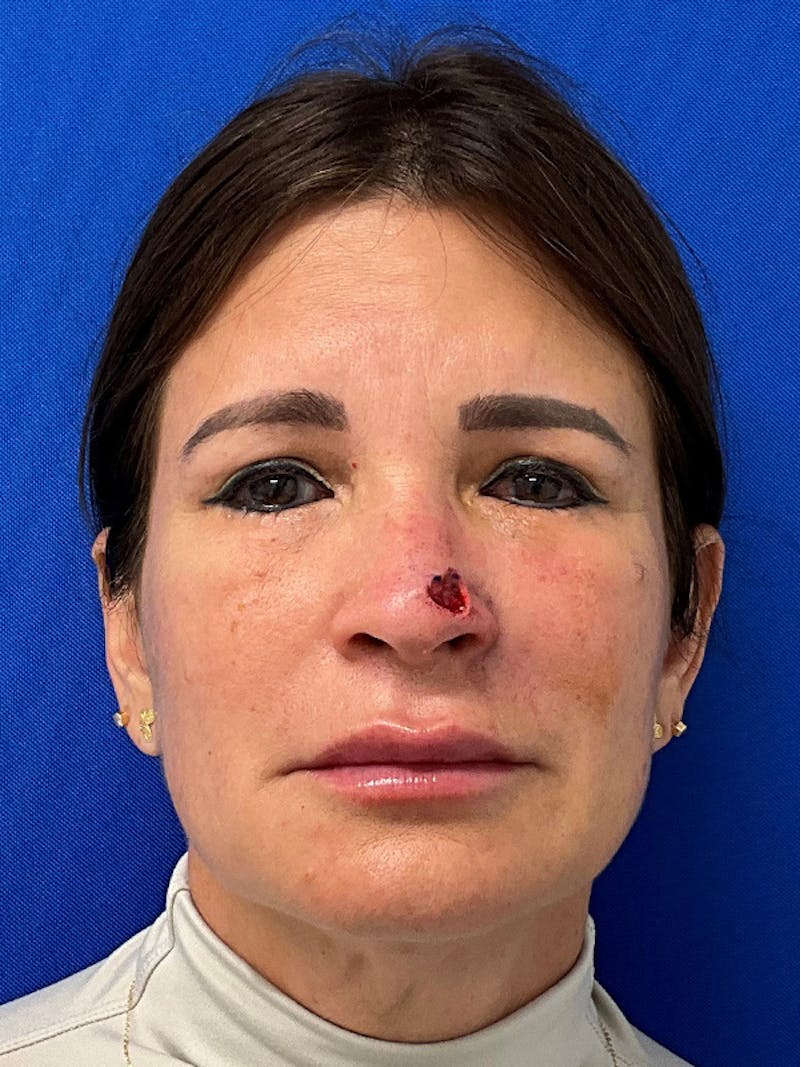 Reconstruction after Mohs Surgery Before & After Gallery - Patient 250804 - Image 1