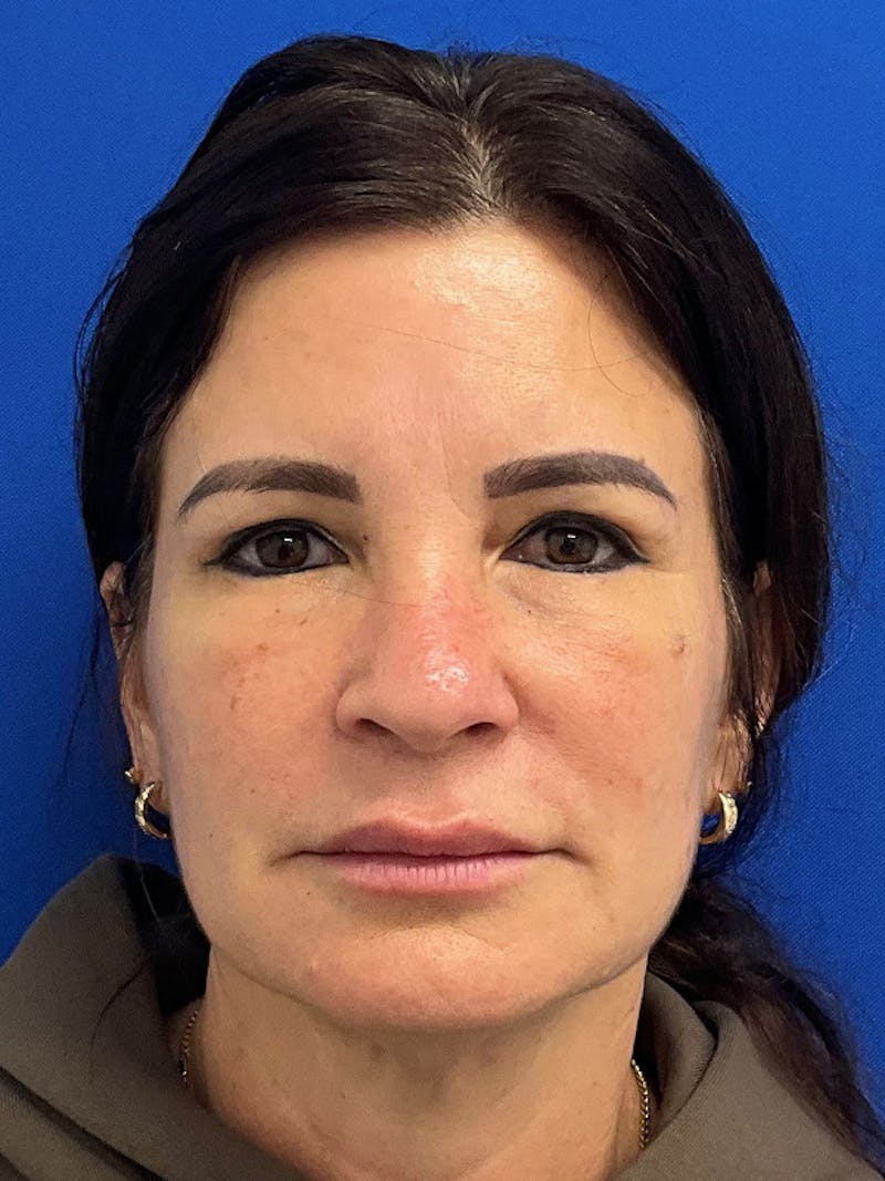 Reconstruction after Mohs Surgery Before & After Gallery - Patient 250804 - Image 2