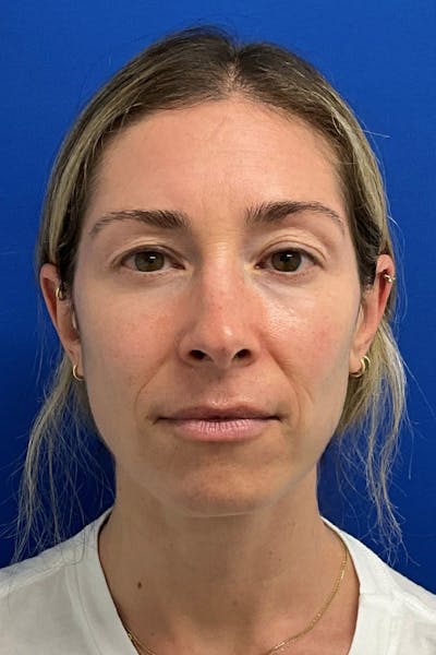 Blepharoplasty Before & After Gallery - Patient 328944 - Image 1