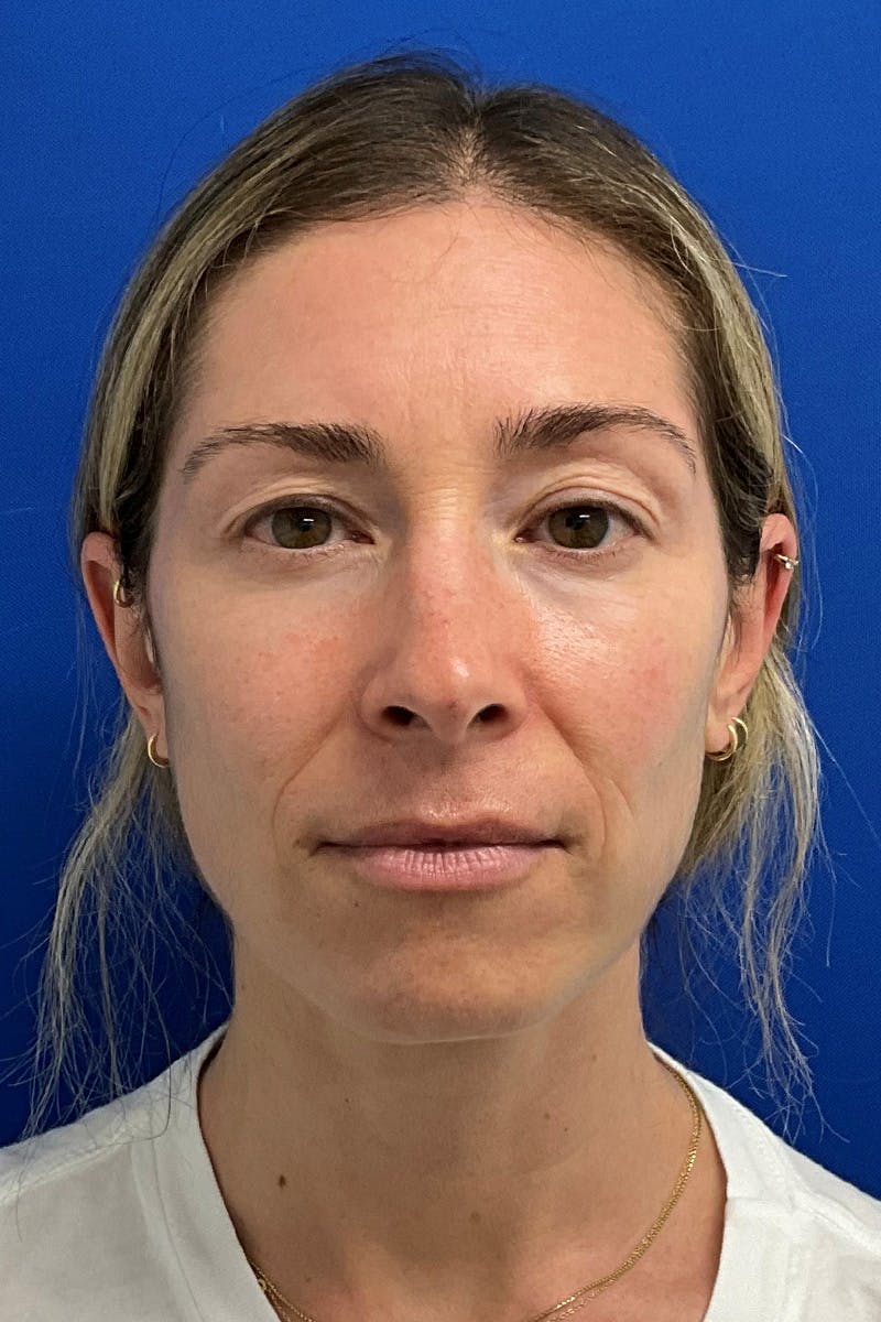 Blepharoplasty Before & After Gallery - Patient 328944 - Image 1