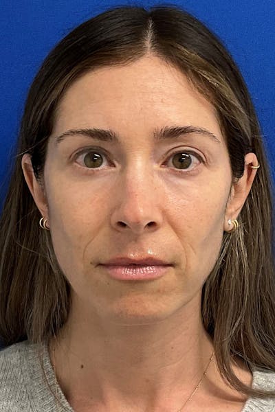 Blepharoplasty Before & After Gallery - Patient 328944 - Image 2