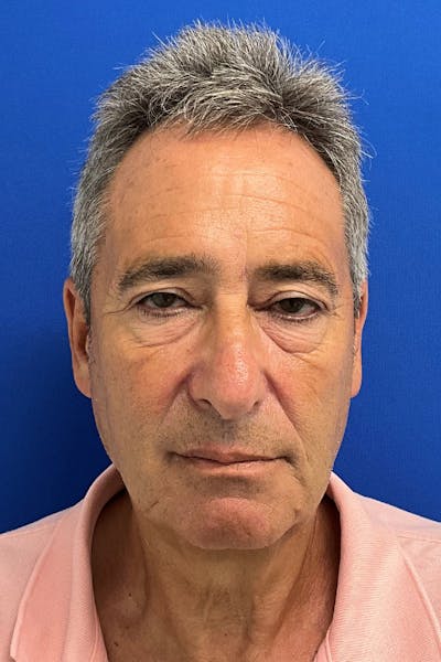 Blepharoplasty Before & After Gallery - Patient 173801 - Image 1