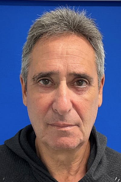 Blepharoplasty Before & After Gallery - Patient 173801 - Image 2