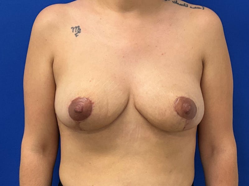 Breast Lift Before & After Gallery - Patient 815258 - Image 2