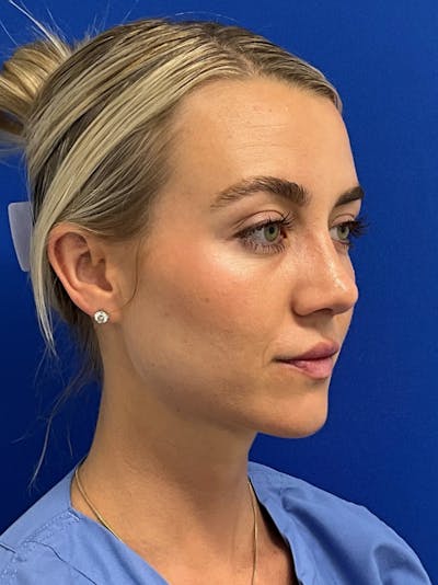 Rhinoplasty Before & After Gallery - Patient 142567 - Image 2