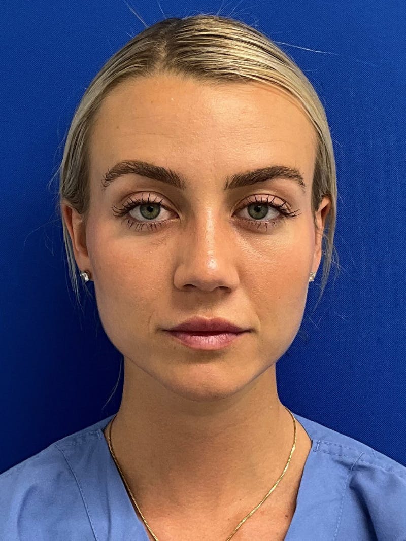 Rhinoplasty Before & After Gallery - Patient 142567 - Image 4