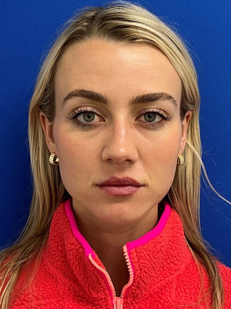 Rhinoplasty Before & After Gallery - Patient 142567 - Image 3