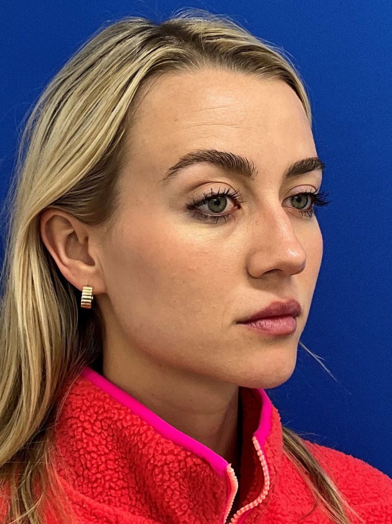 Rhinoplasty Before & After Gallery - Patient 142567 - Image 1