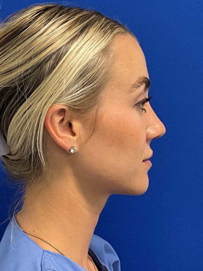 Rhinoplasty Before & After Gallery - Patient 142567 - Image 6