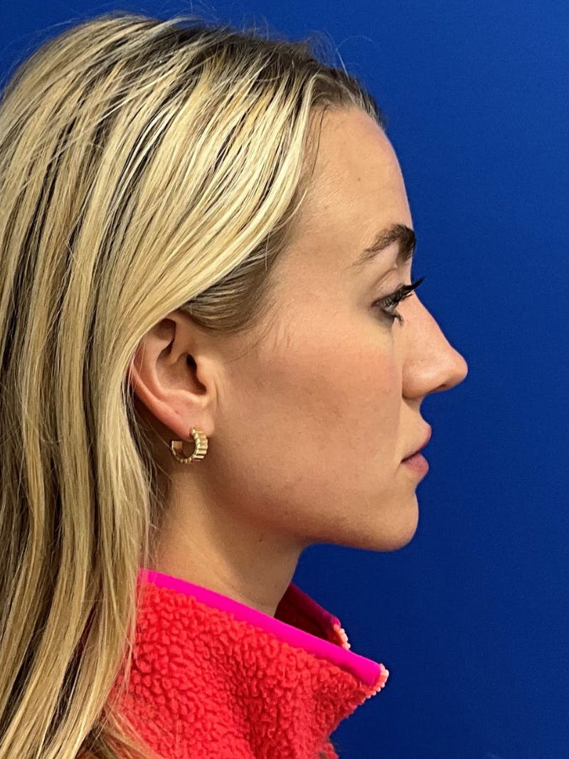 Rhinoplasty Before & After Gallery - Patient 142567 - Image 5