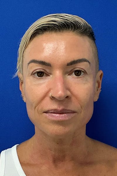 Blepharoplasty Before & After Gallery - Patient 168095 - Image 2