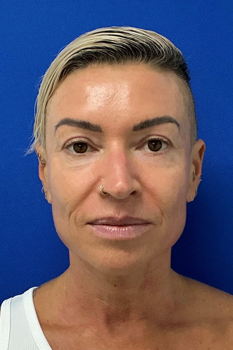 Blepharoplasty Before & After Gallery - Patient 168095 - Image 2