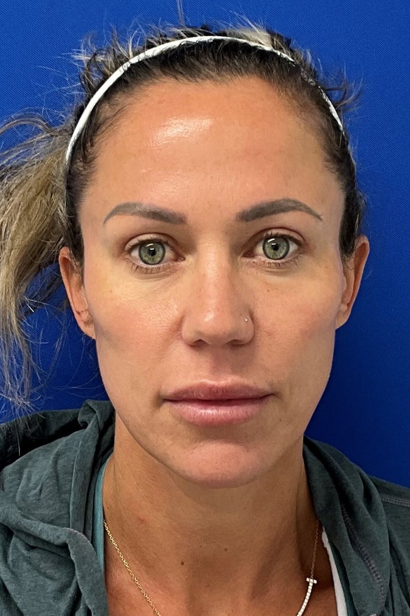 Blepharoplasty Before & After Gallery - Patient 374308 - Image 2