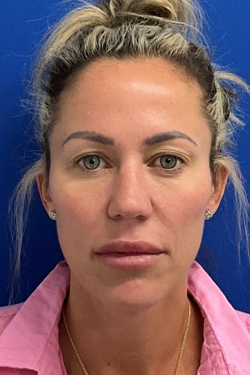 Blepharoplasty Before & After Gallery - Patient 374308 - Image 1