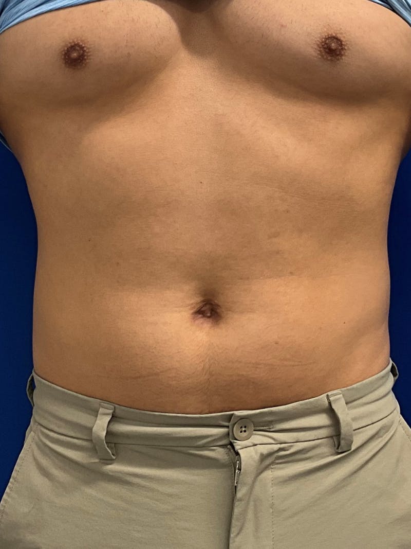 Umbilicoplasty Before & After Gallery - Patient 511548 - Image 2