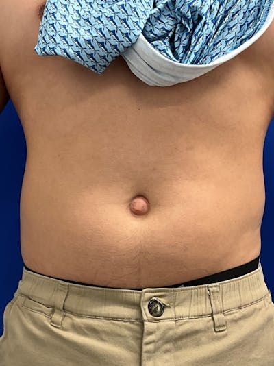 Umbilicoplasty Before & After Gallery - Patient 511548 - Image 1