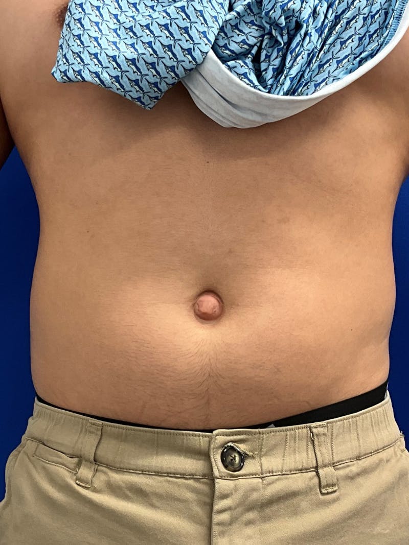 Umbilicoplasty Before & After Gallery - Patient 511548 - Image 1