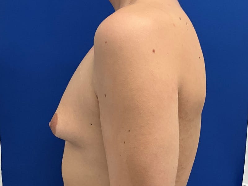 Gynecomastia  Before & After Gallery - Patient 417667 - Image 3