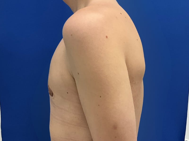 Gynecomastia  Before & After Gallery - Patient 417667 - Image 4