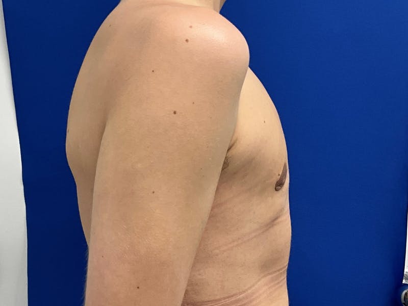 Gynecomastia  Before & After Gallery - Patient 417667 - Image 6
