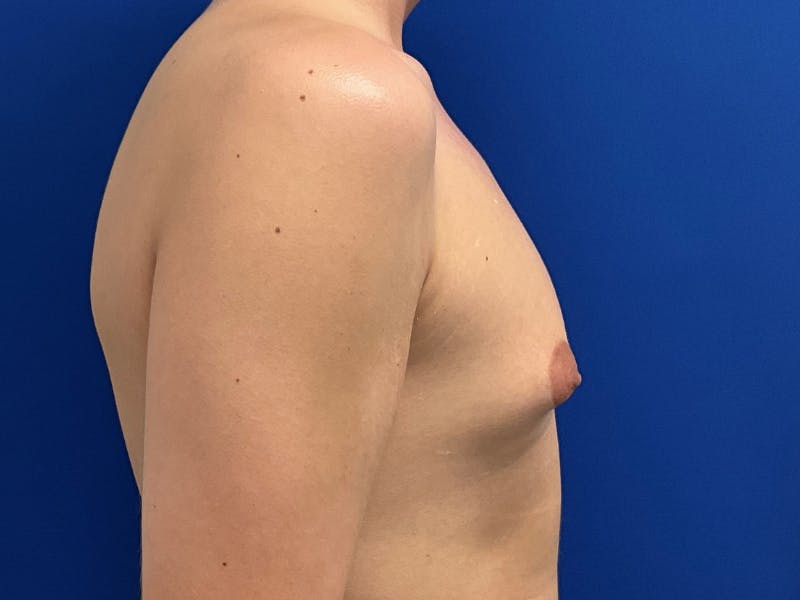 Gynecomastia  Before & After Gallery - Patient 417667 - Image 5