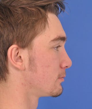 right front-after